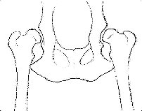 Dysplasie grave